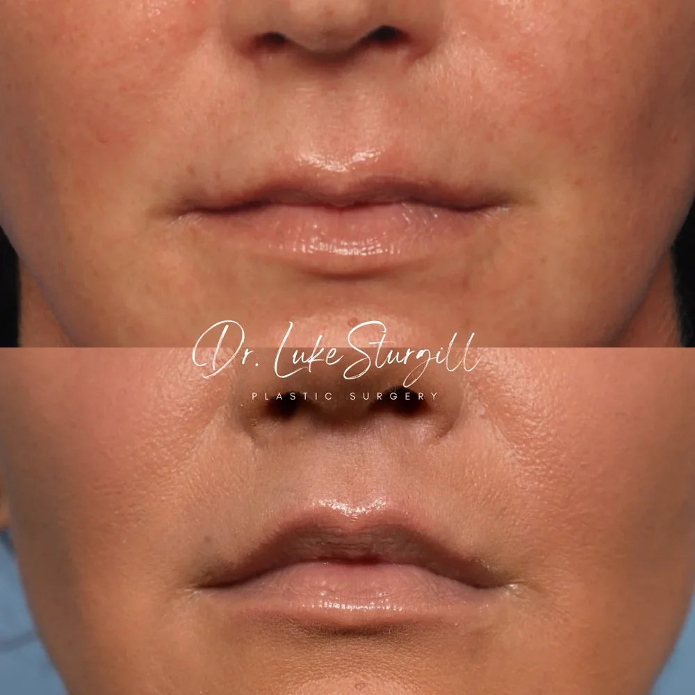 Subnasal lip lift before and after — oblique view — female patient