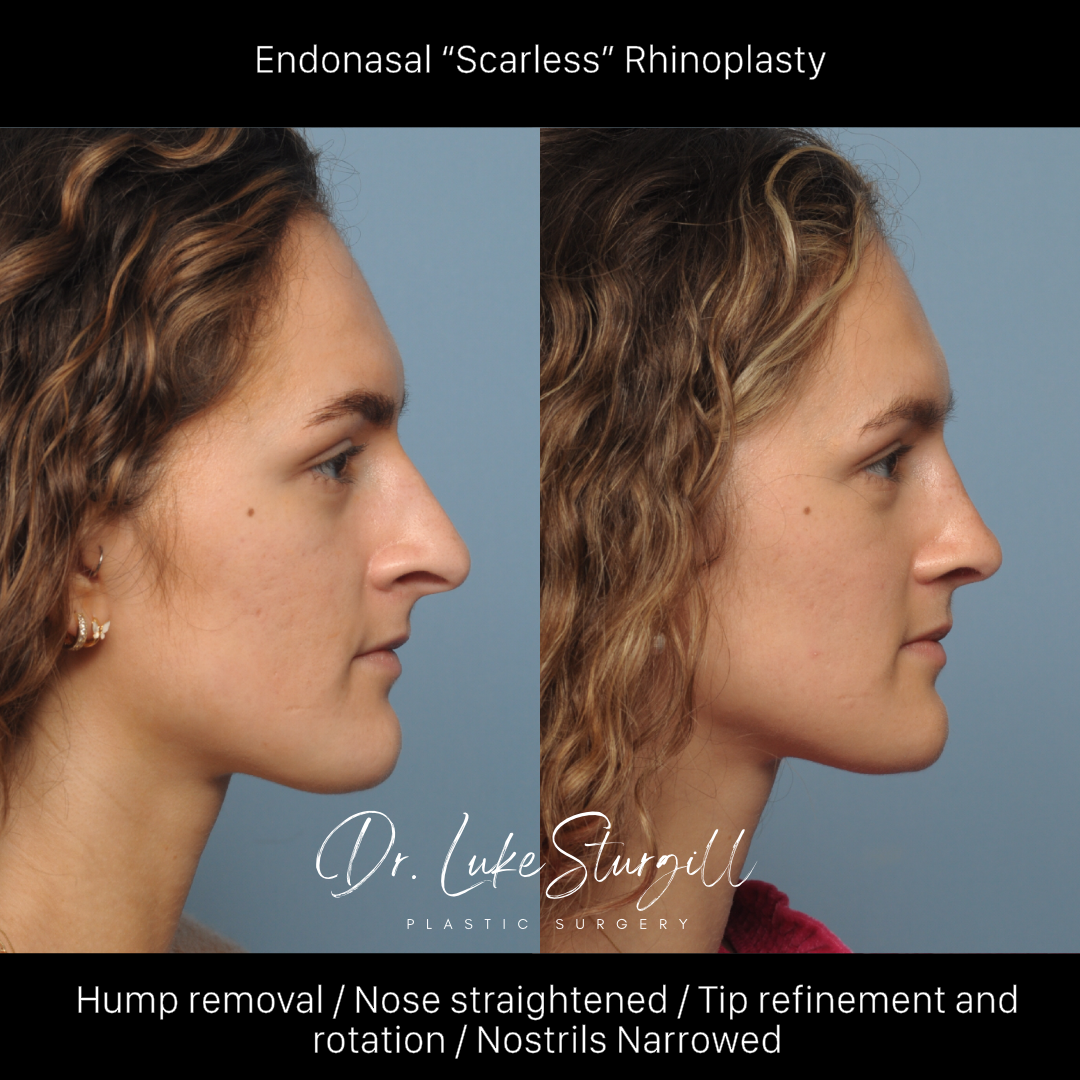 Rhinoplasty before and after — lateral view — female patient