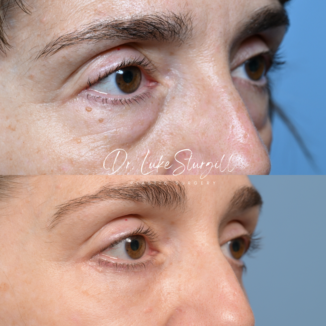 Eyelid surgery before and after — oblique view — female patient