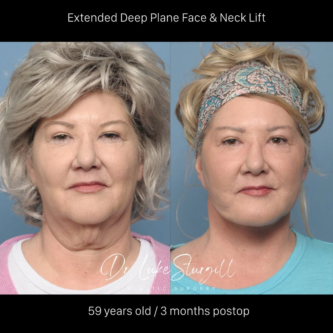 Deep plane facelift before and after — oblique view — female patient