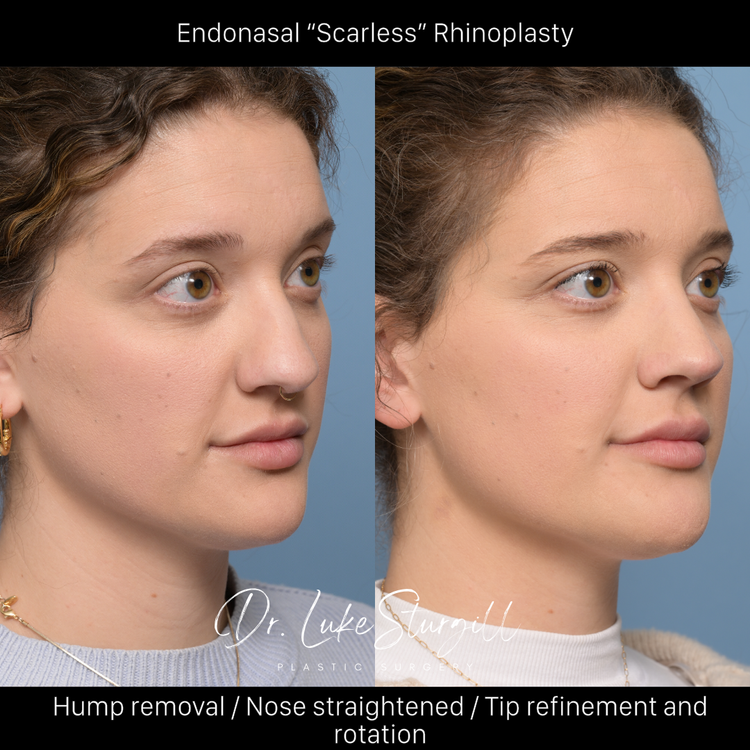 Rhinoplasty Before and After