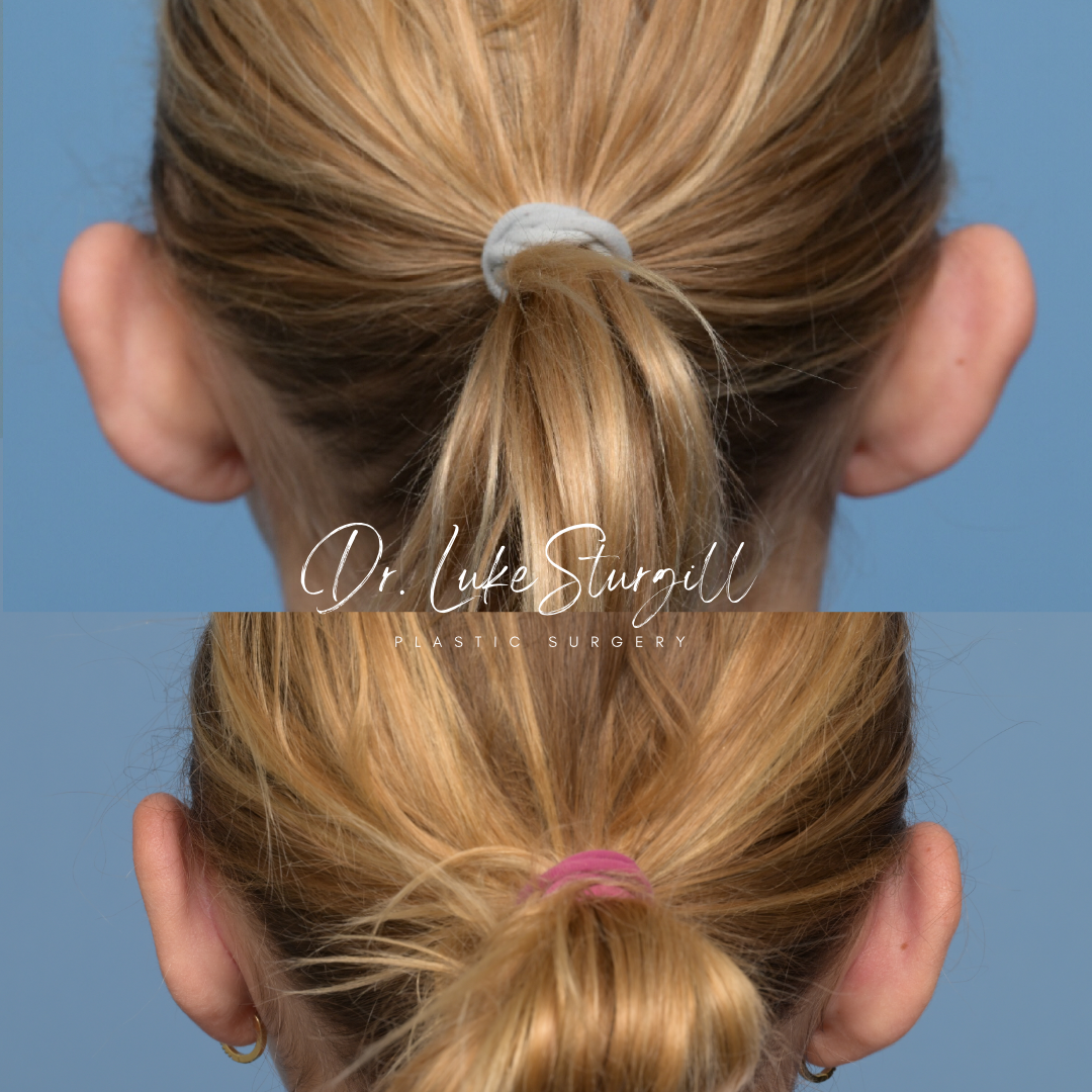 Otoplasty before and after—ear repositioning by Dr. Sturgill