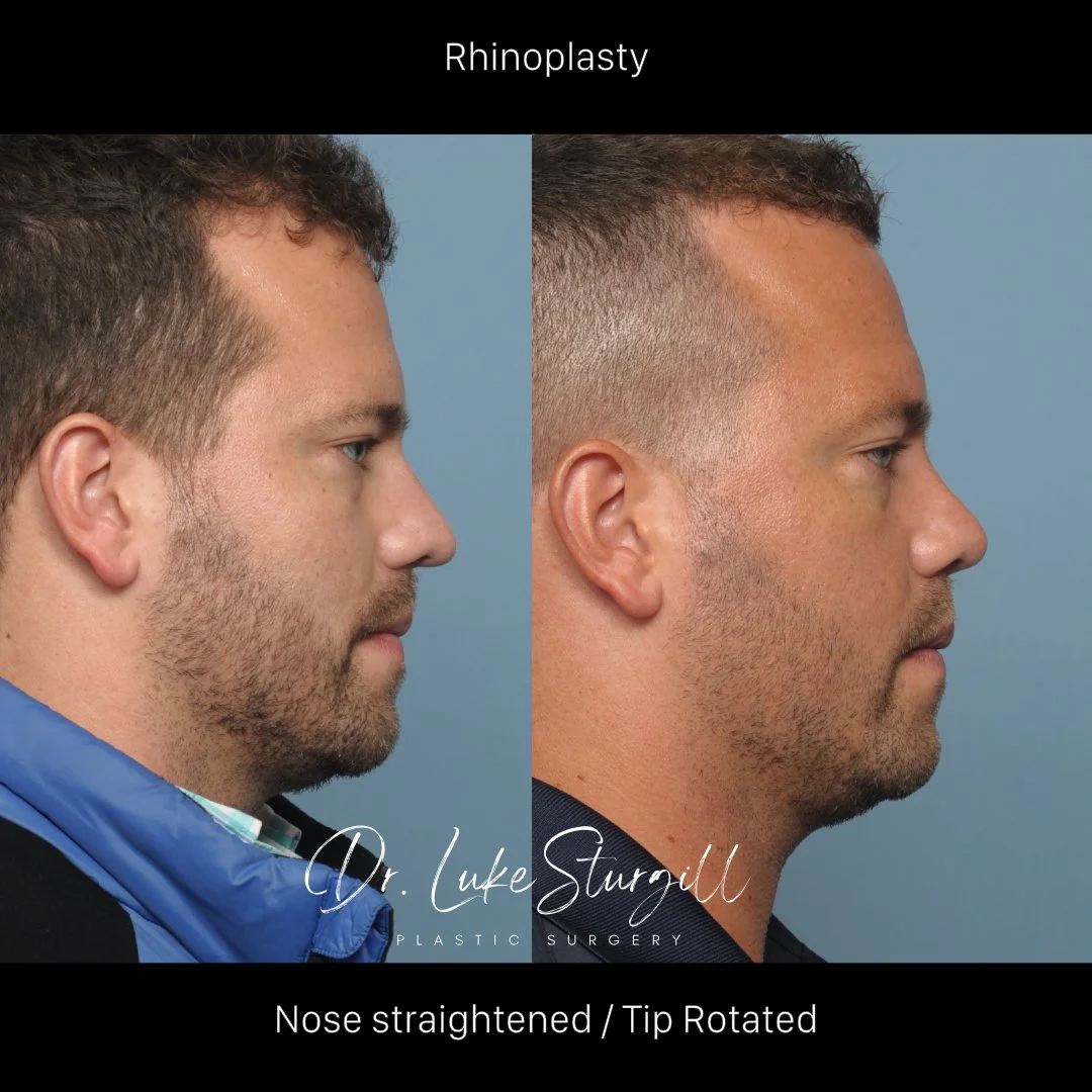 Rhinoplasty before and after — front view — female patient
