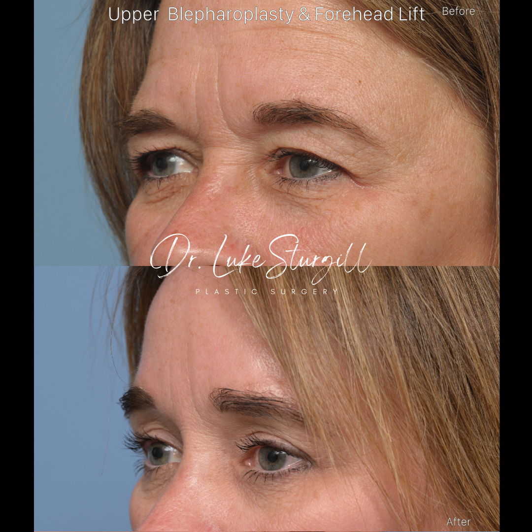Eyelid surgery before and after — oblique view — female patient