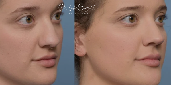Rhinoplasty Result