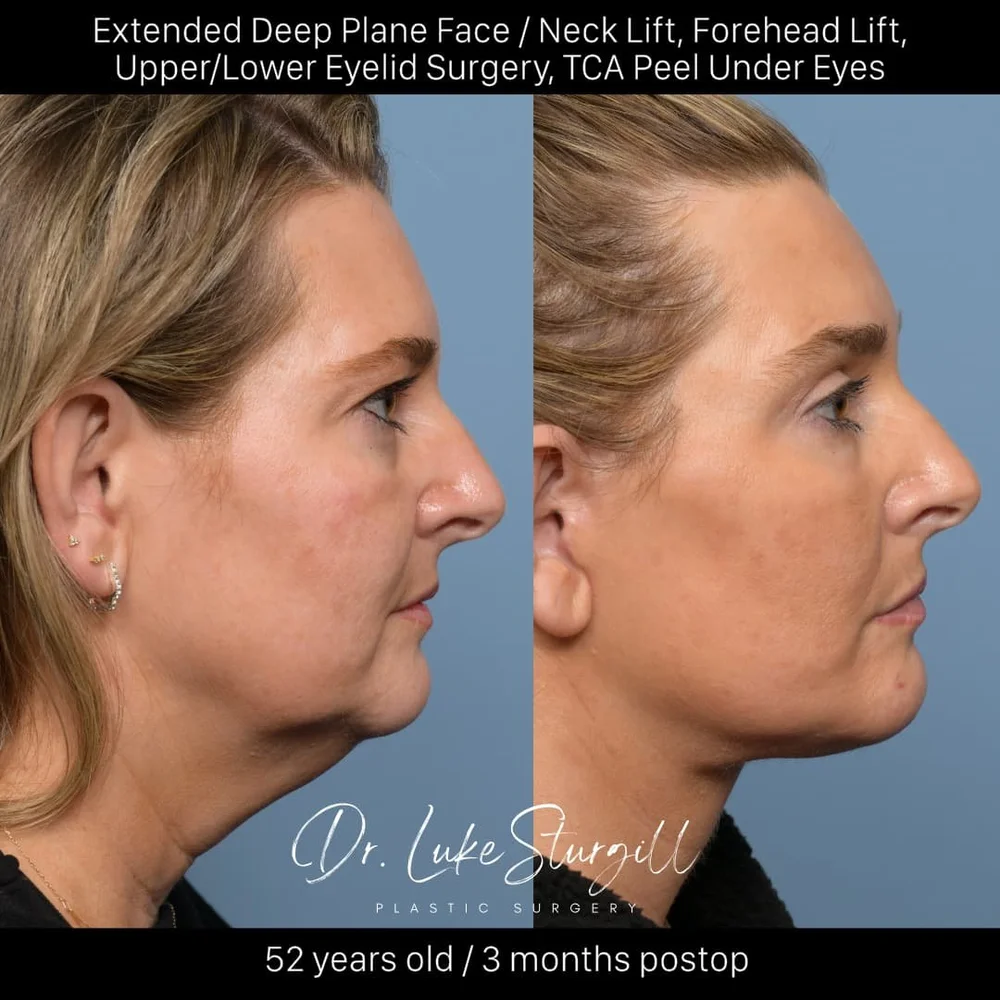 Deep plane facelift before and after — lateral view — female patient