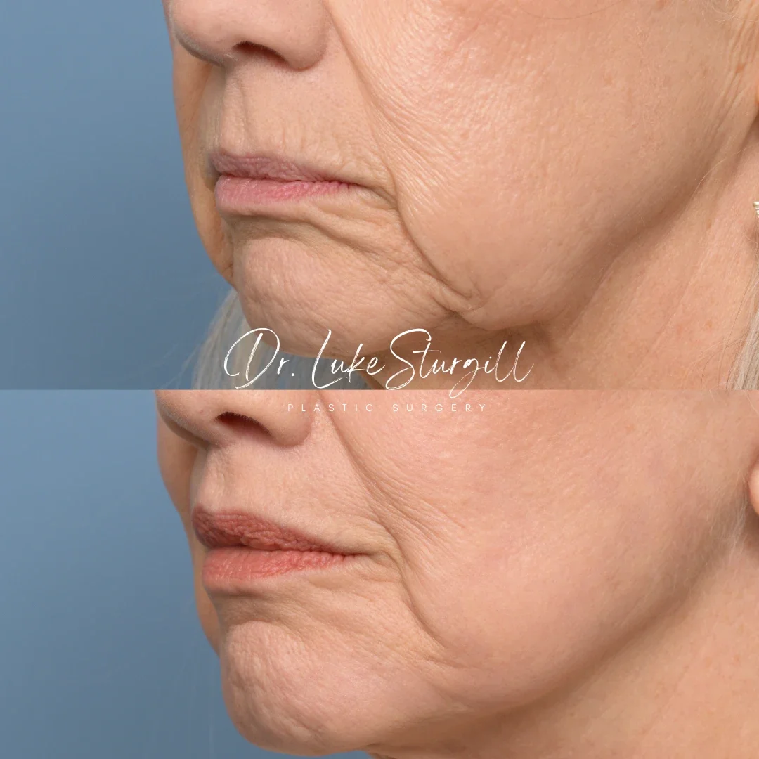 Lip lift before and after — oblique view — female patient