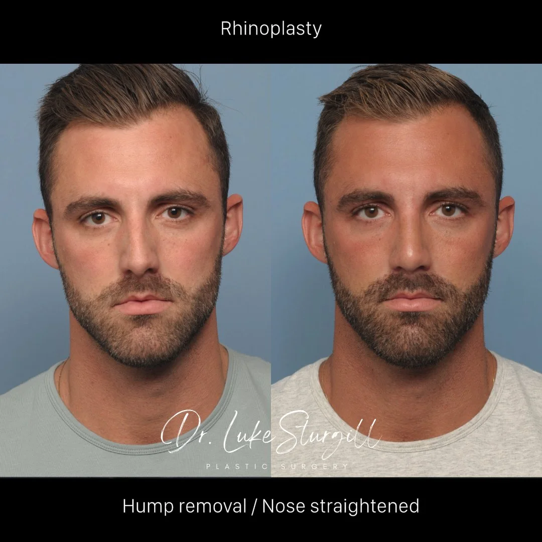 Rhinoplasty before and after — front view — male patient