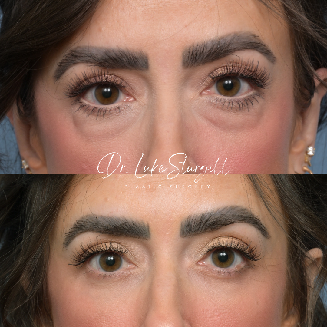 Eyelid surgery before and after — close-up — female patient
