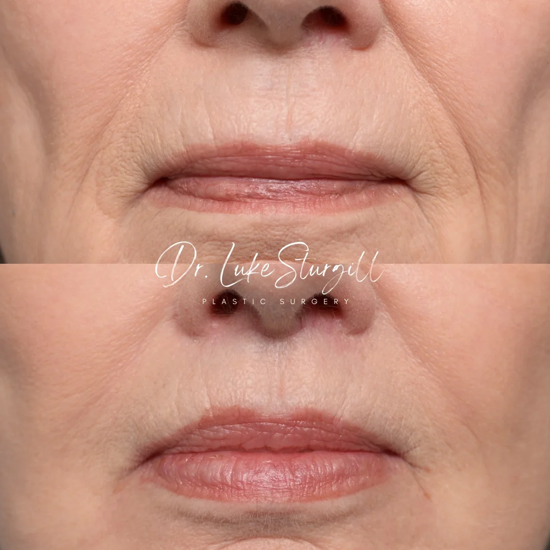 Lip lift before and after — front view — female patient