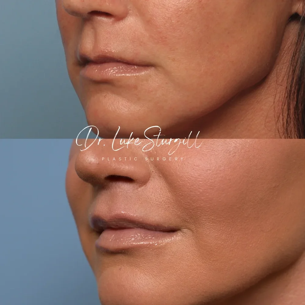 Subnasal lip lift before and after — front view — female patient