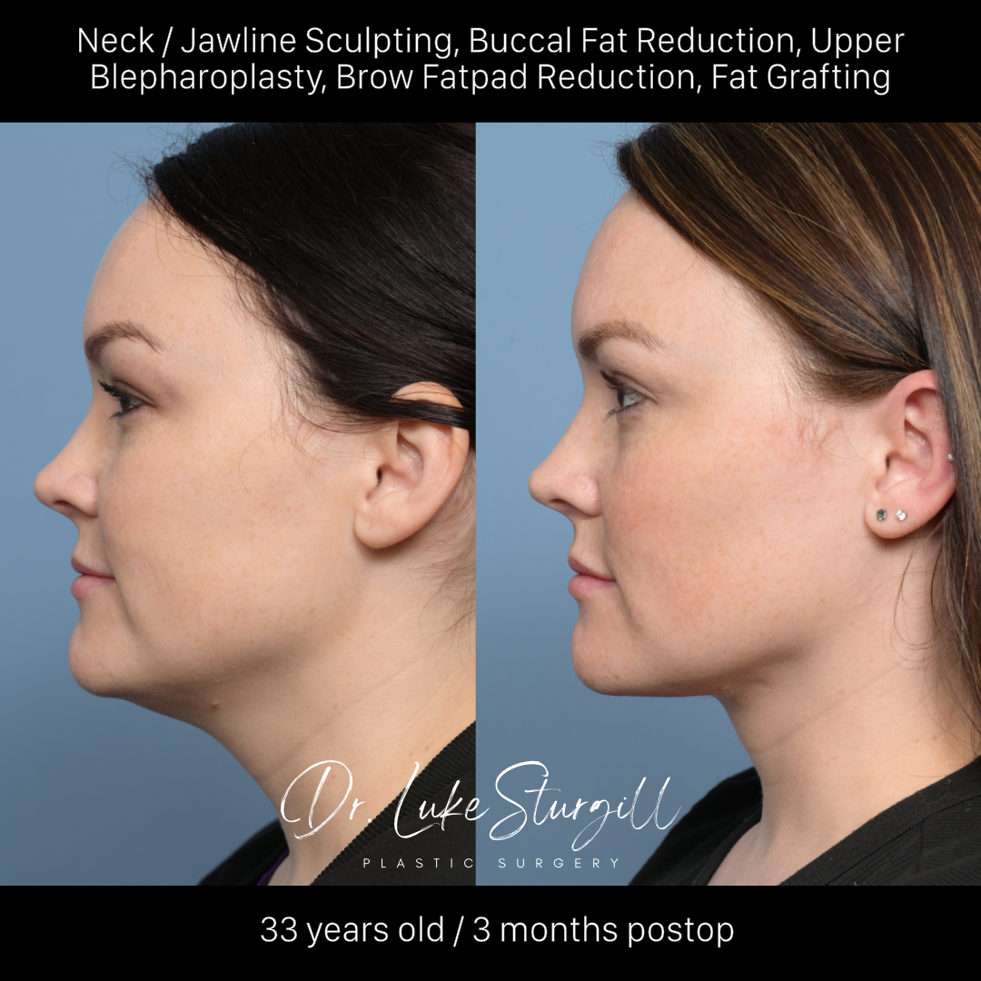 Neck and jawline sculpting before and after — front view — female patient