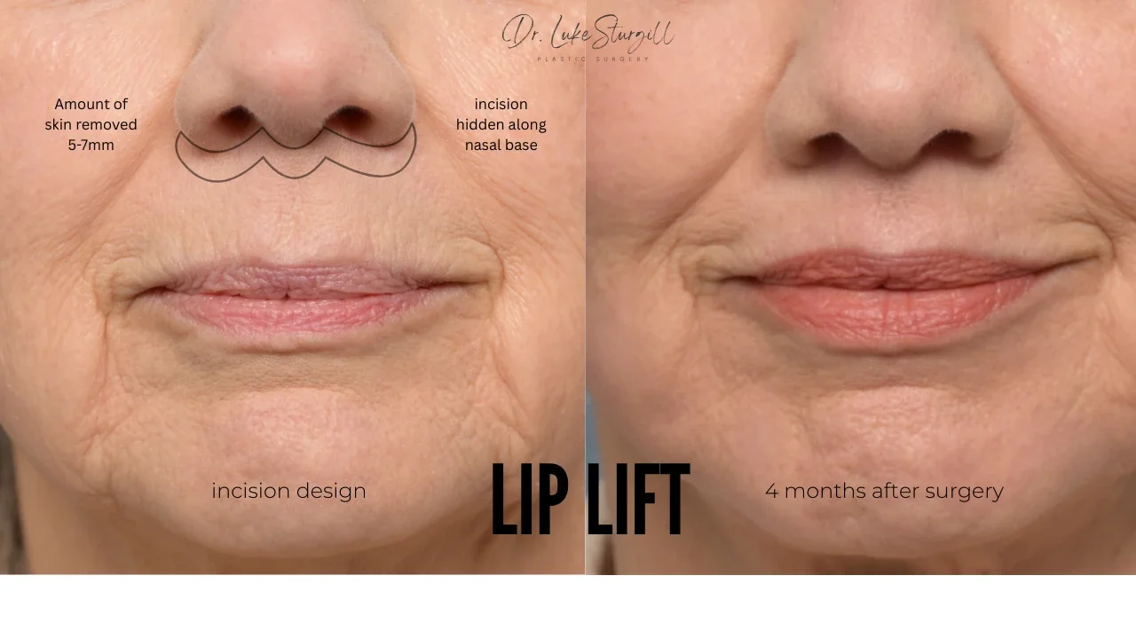 Lip lift before and after showing bullhorn incision design at the base of the nose and healed result at four months
