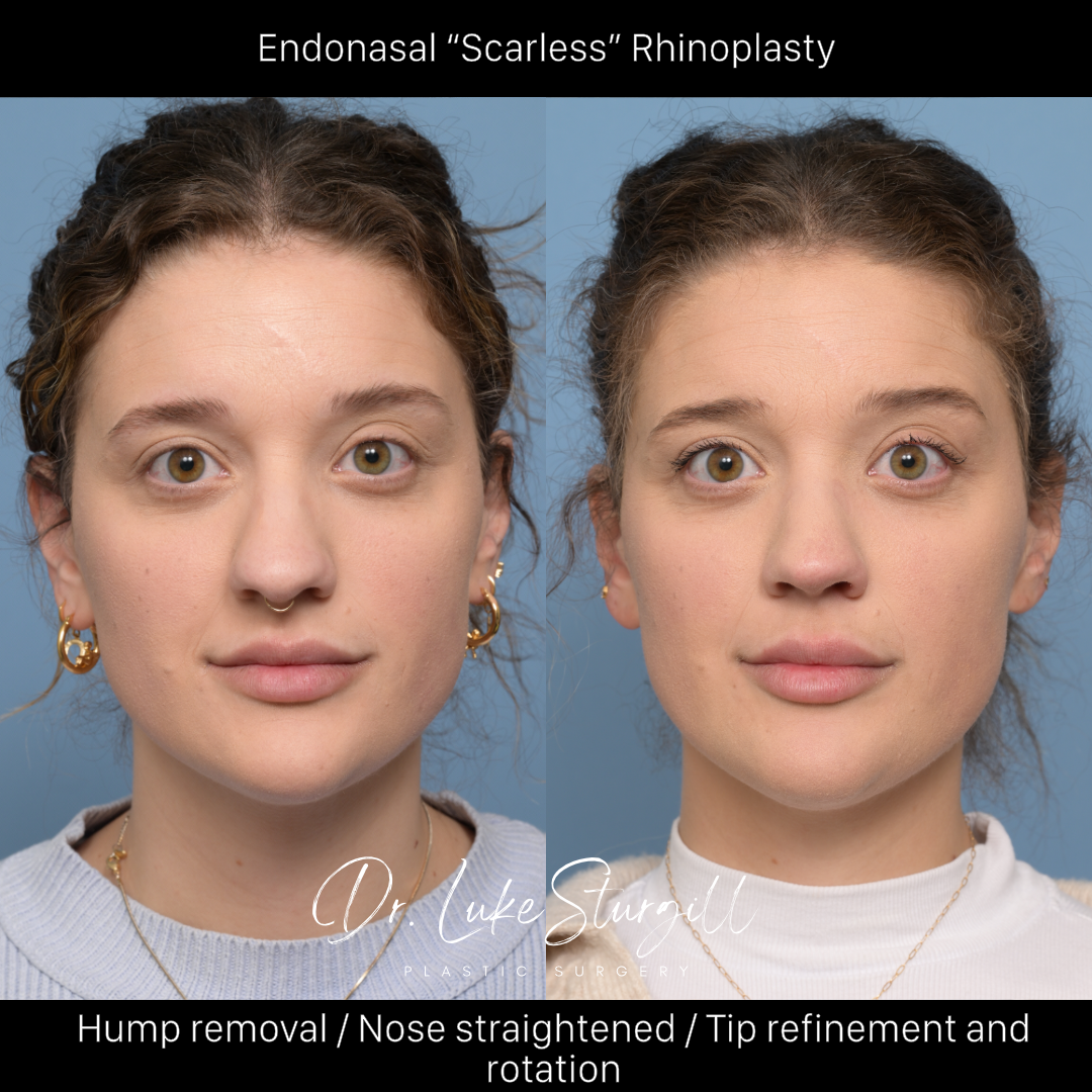 Rhinoplasty before and after — base view — female patient