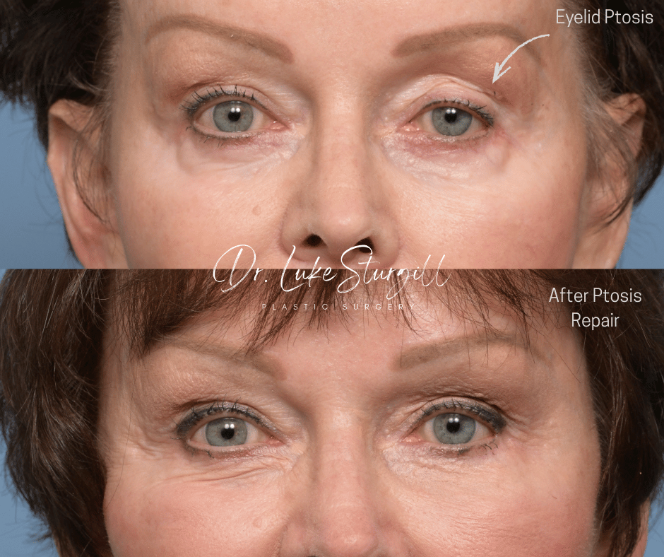 Before and after left eye ptosis repair and fat grafting by Dr. R. Luke Sturgill