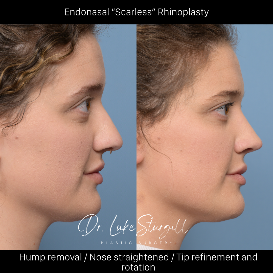Rhinoplasty before and after — front view — female patient