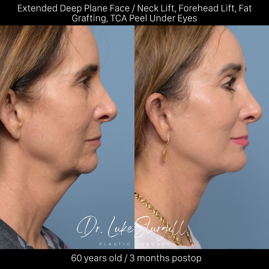 Deep plane facelift before and after — front view — female patient