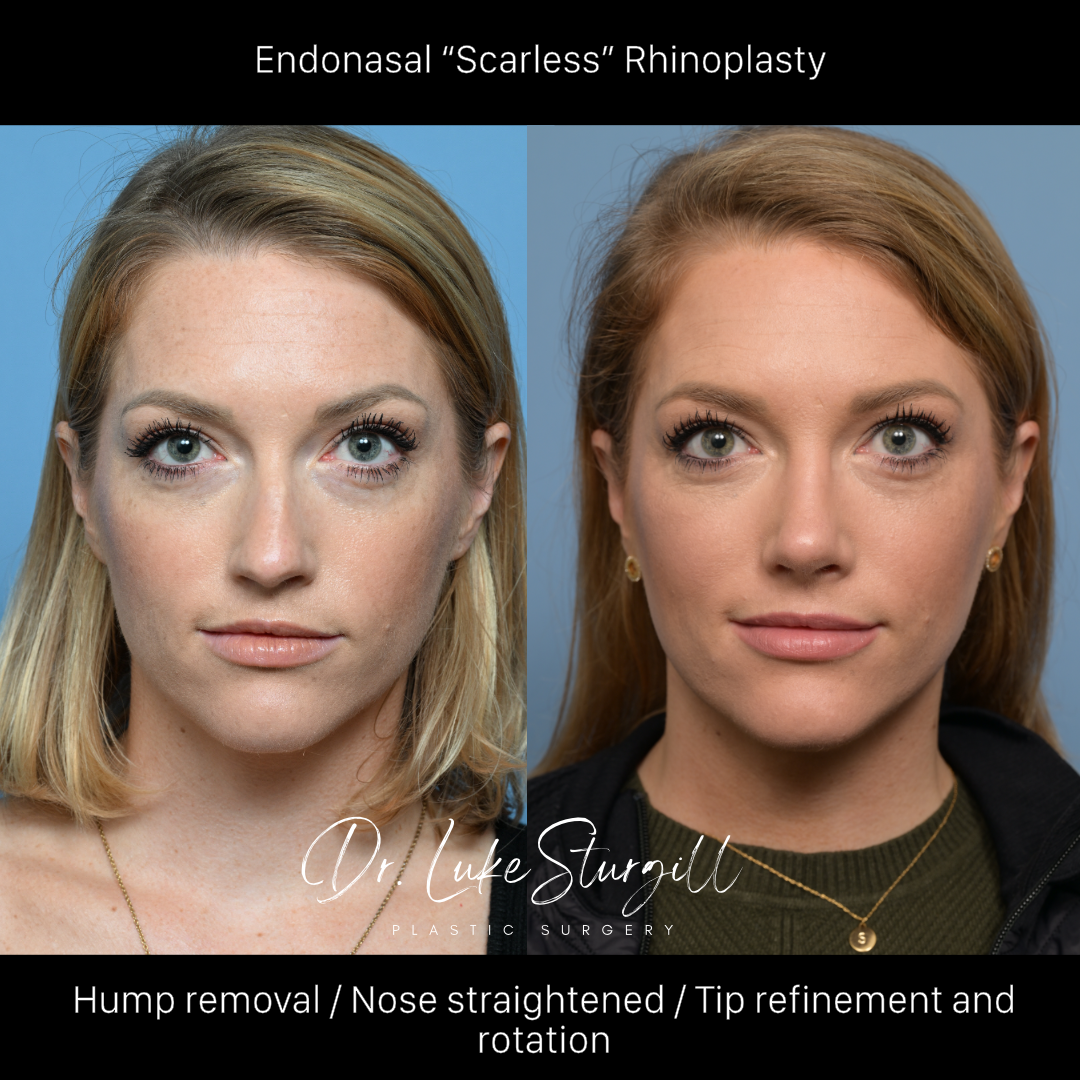 Rhinoplasty before and after — front view — female patient