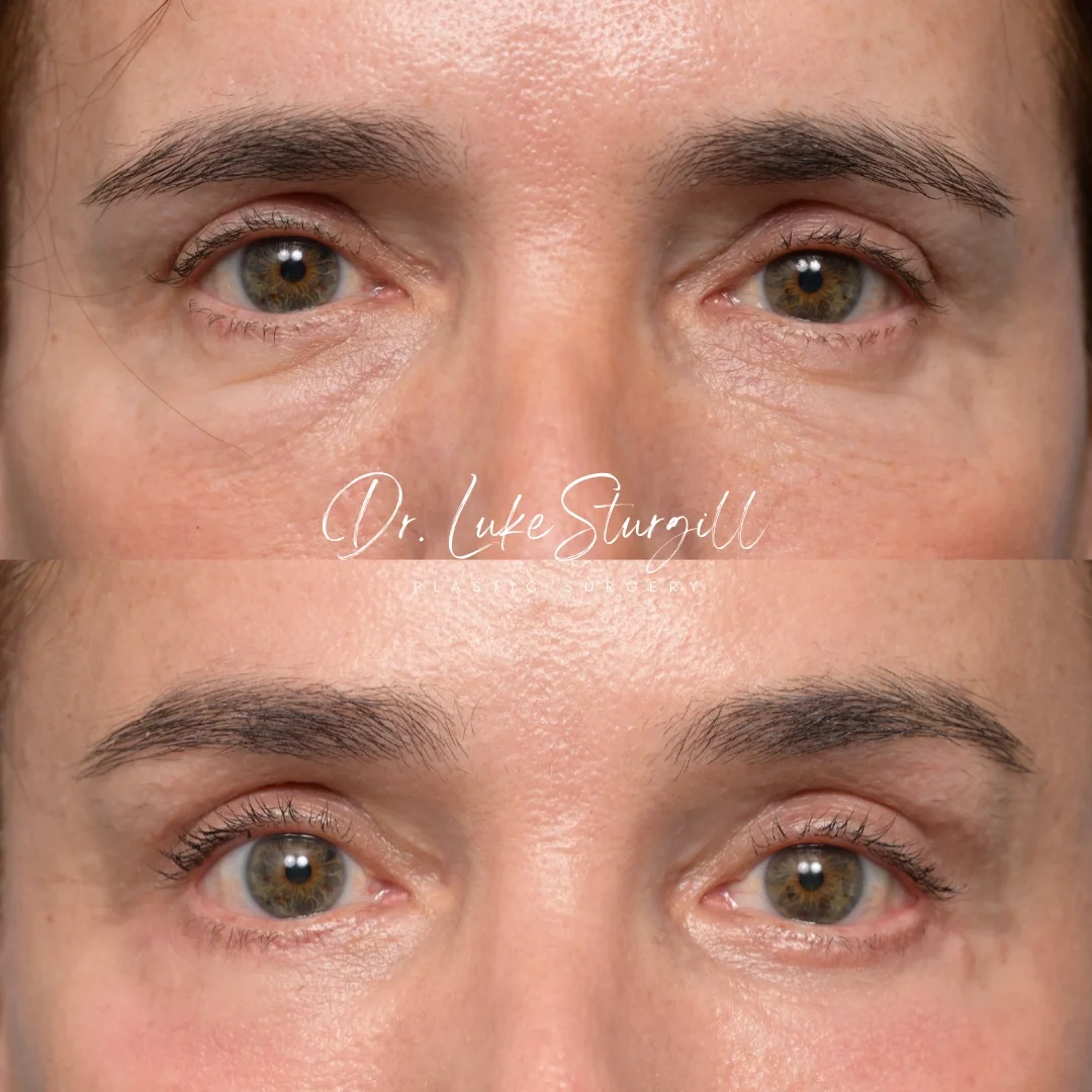 Close-up of a woman's face showing before and after eyelid surgery, focusing on the eyes and eyebrows.