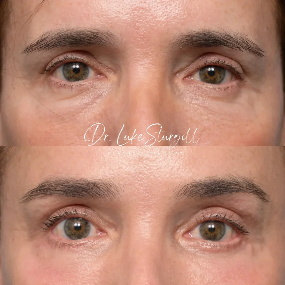 Eyelid surgery before and after — oblique view — female patient