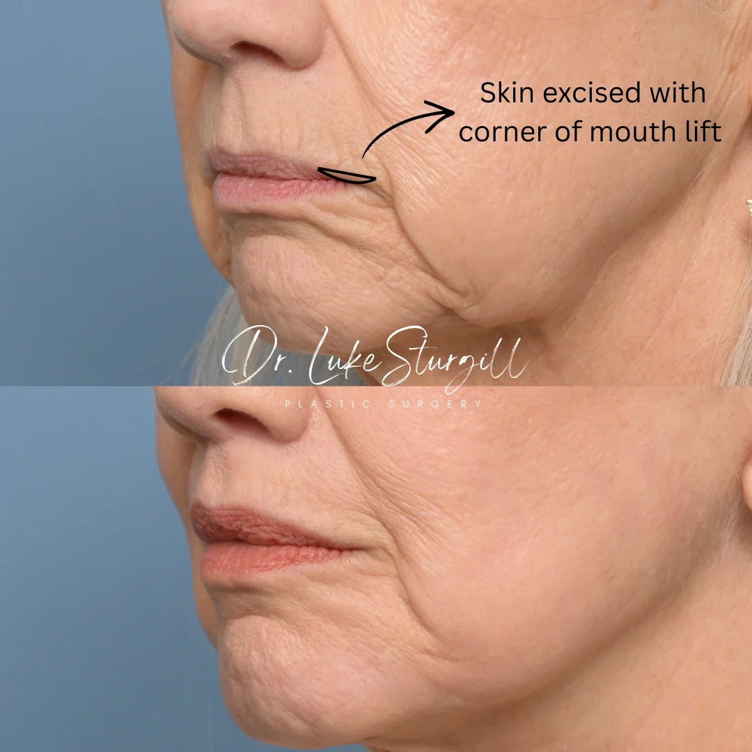 Diagram showing corner of mouth lift technique and scar placement at the oral commissures