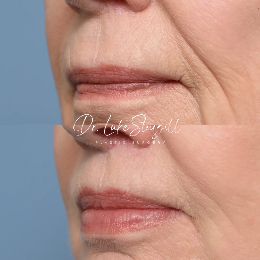 Lip lift before and after — oblique view — female patient