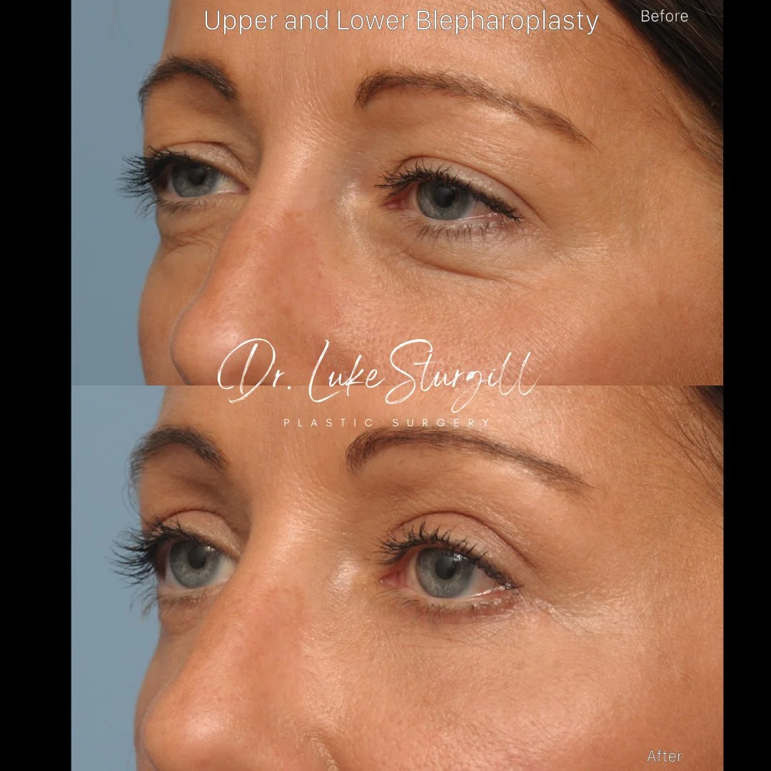 Upper blepharoplasty before and after — lateral view — female patient