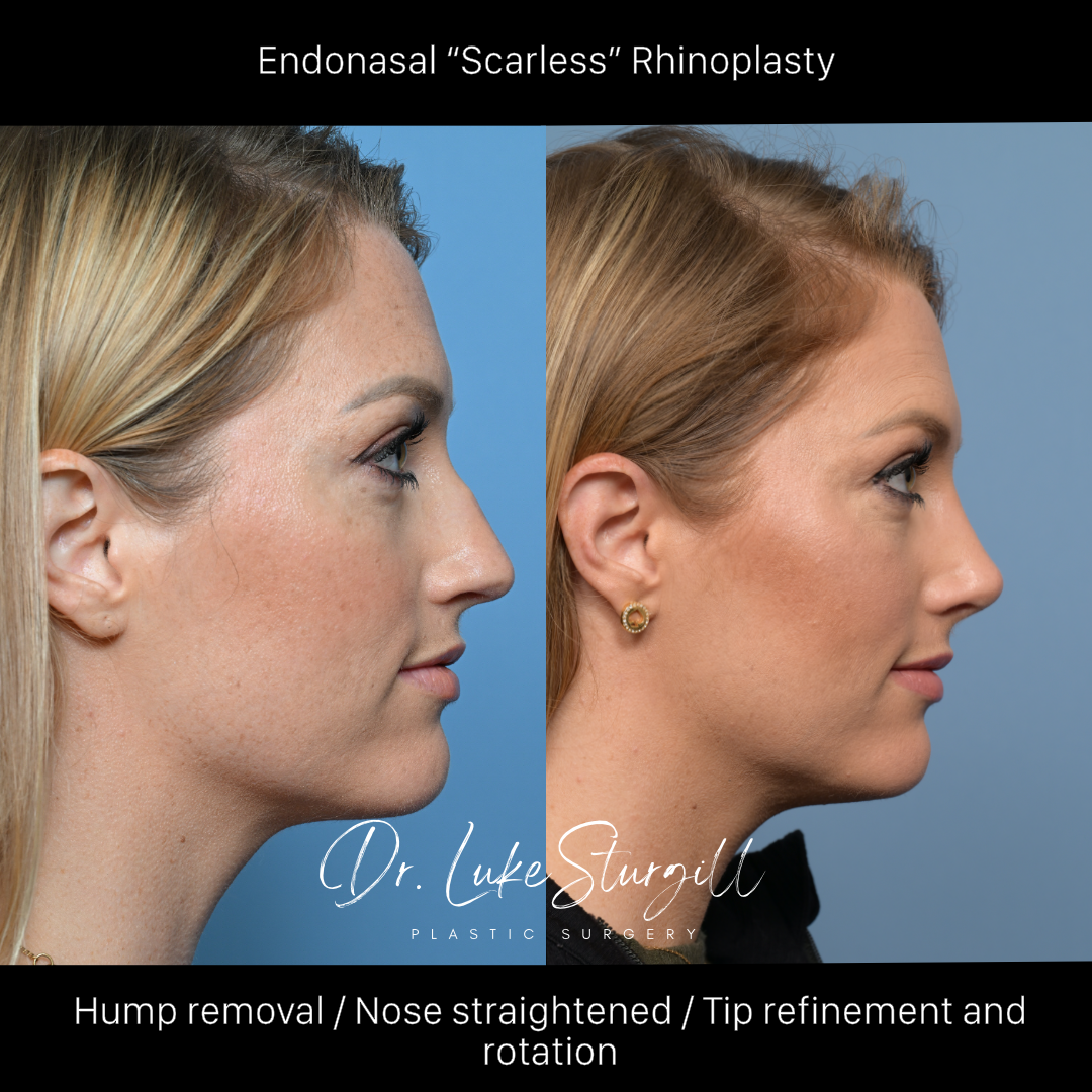 Rhinoplasty before and after — oblique view — female patient