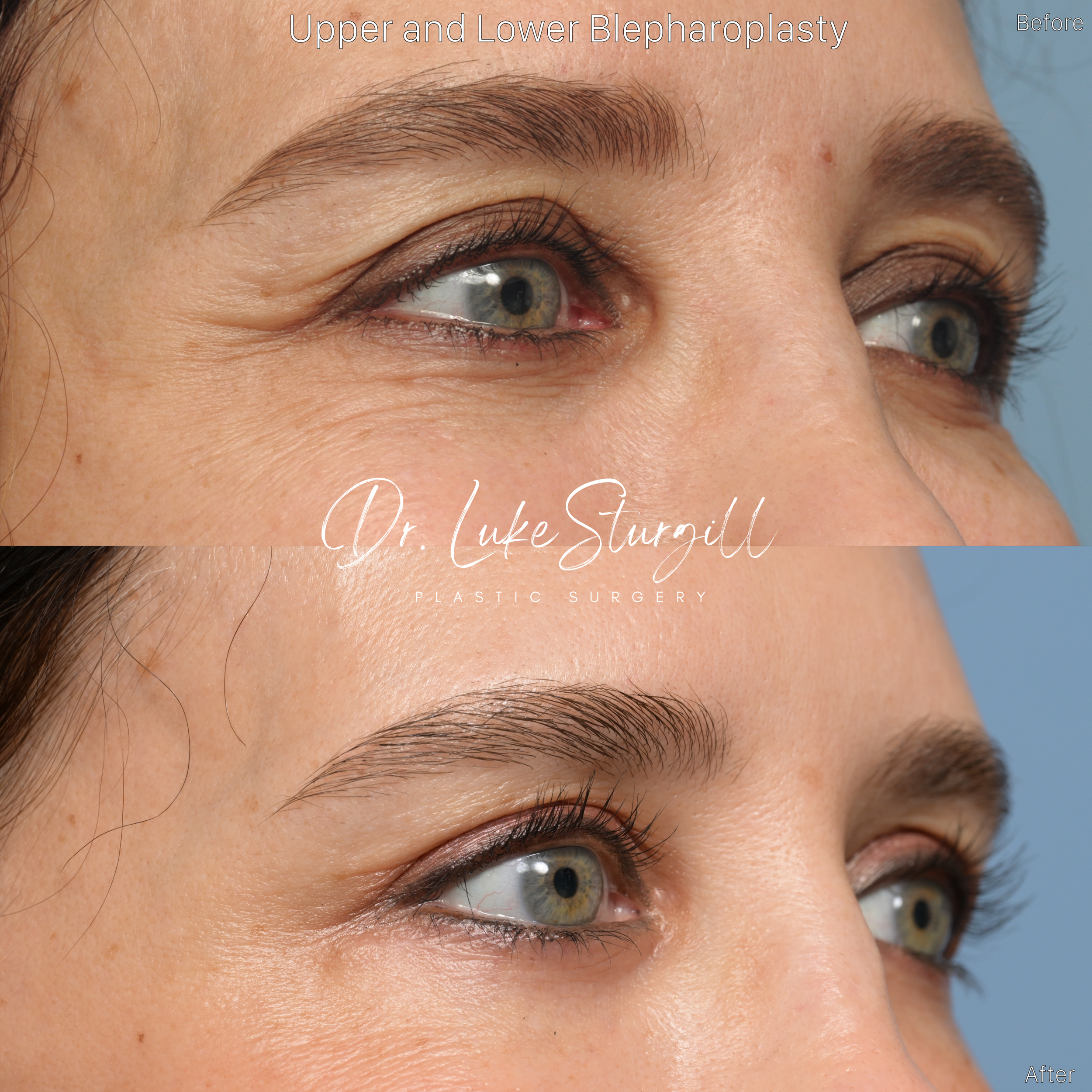 Eyelid surgery before and after — front view — female patient