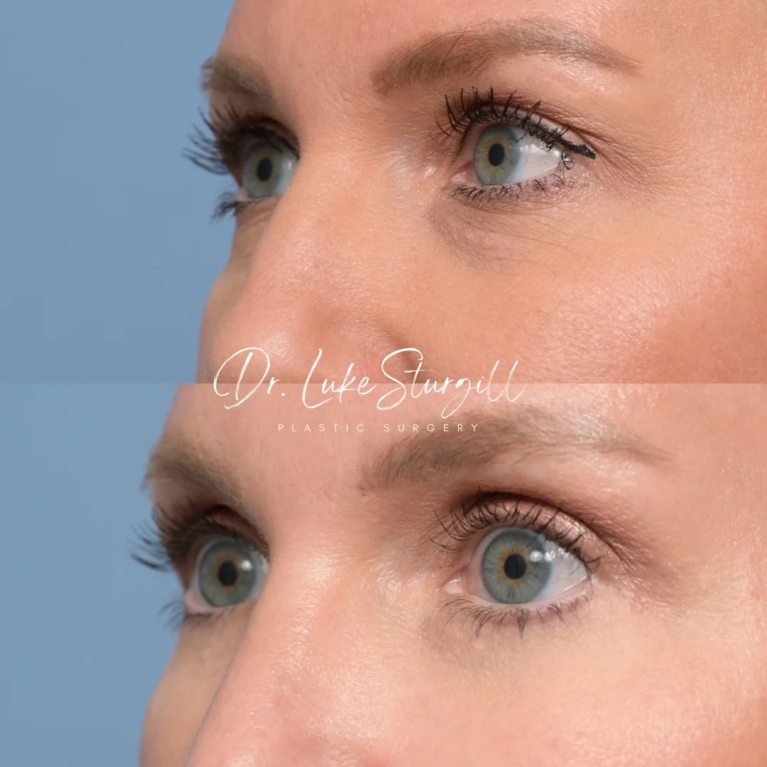 Close-up of a woman's eyes showing before and after results of a cosmetic procedure, with text overlay for Dr. Luke Sturgill Plastic Surgery.