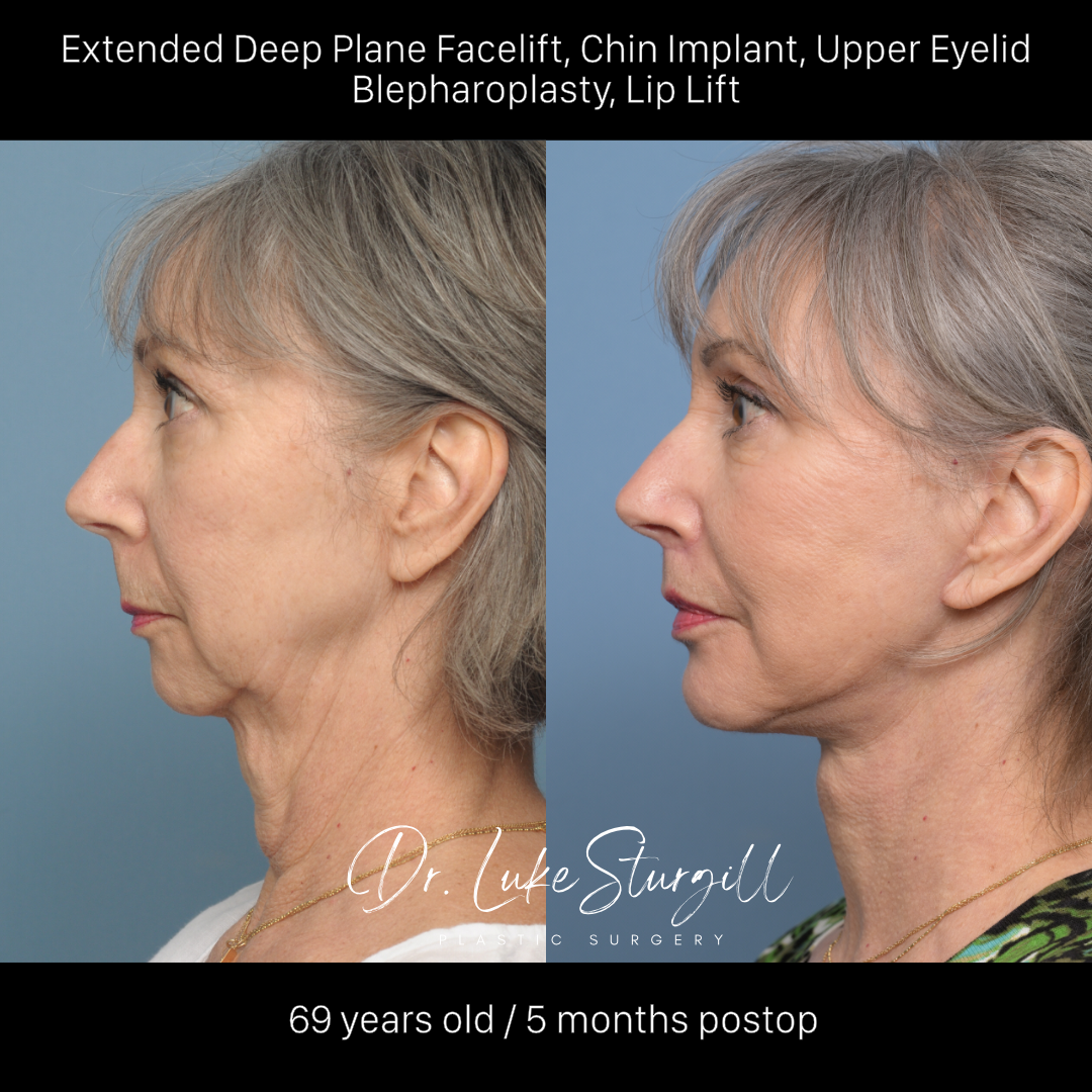 Deep plane facelift before and after — front view — female patient