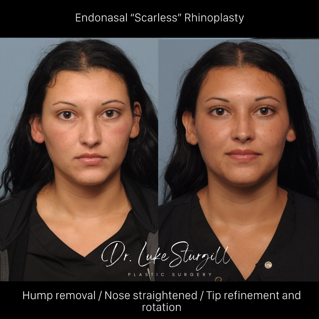 Rhinoplasty before and after — front view — female patient