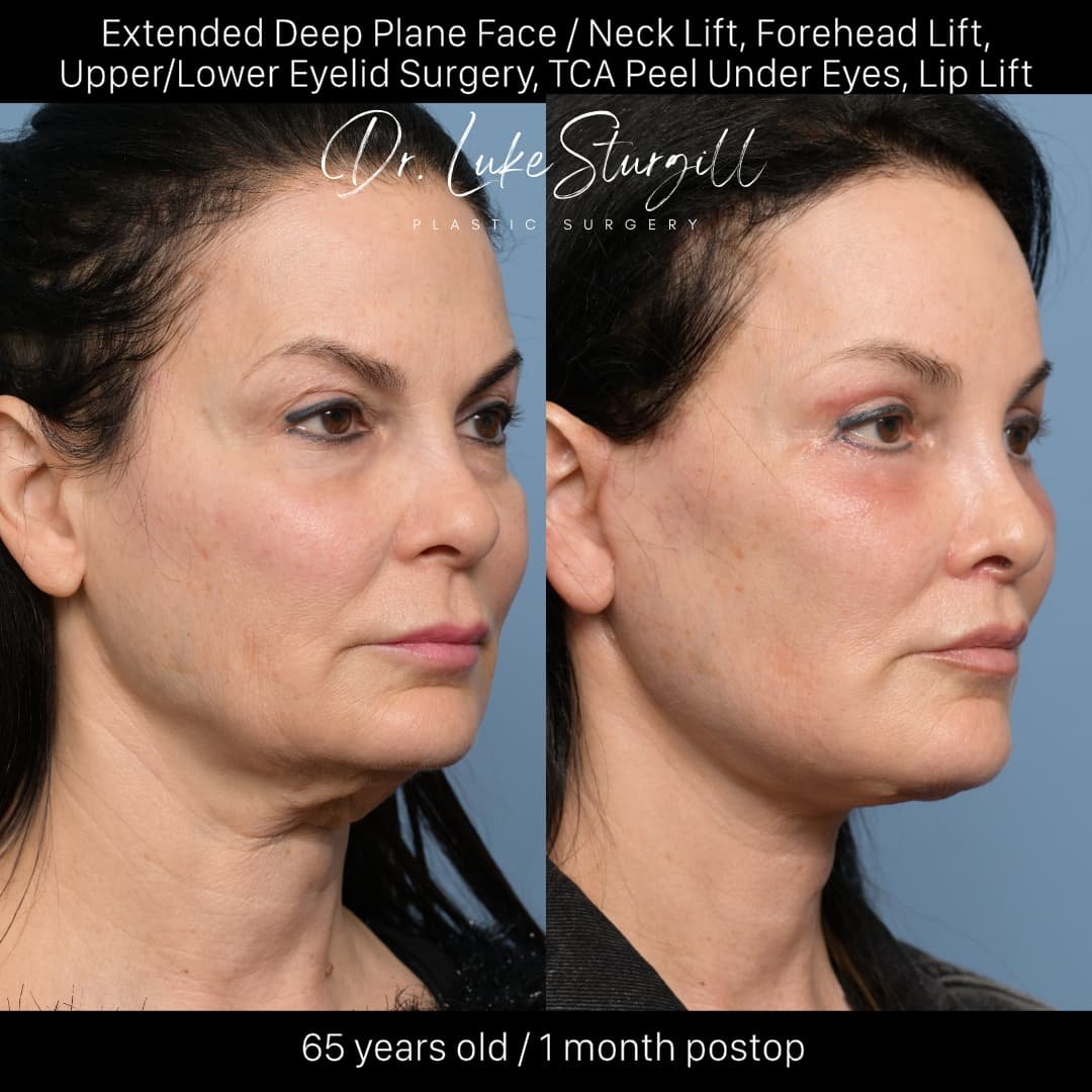 Side-by-side comparison of a 65-year-old woman's face showing the results of cosmetic surgery, with improvements in her facial features one month after the procedure.