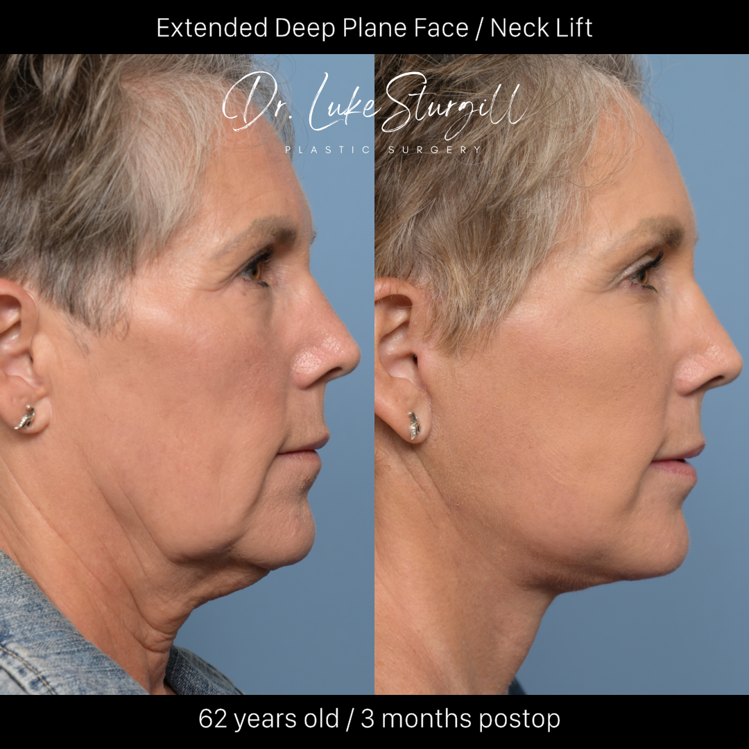 Deep plane facelift before and after — front view — female patient
