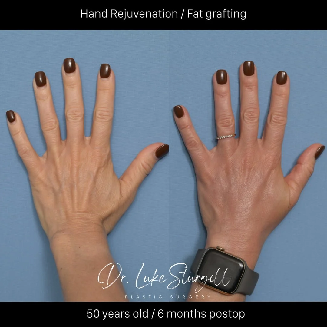Before and after hand rejuvenation with fat grafting by Dr. R. Luke Sturgill — enlarged view