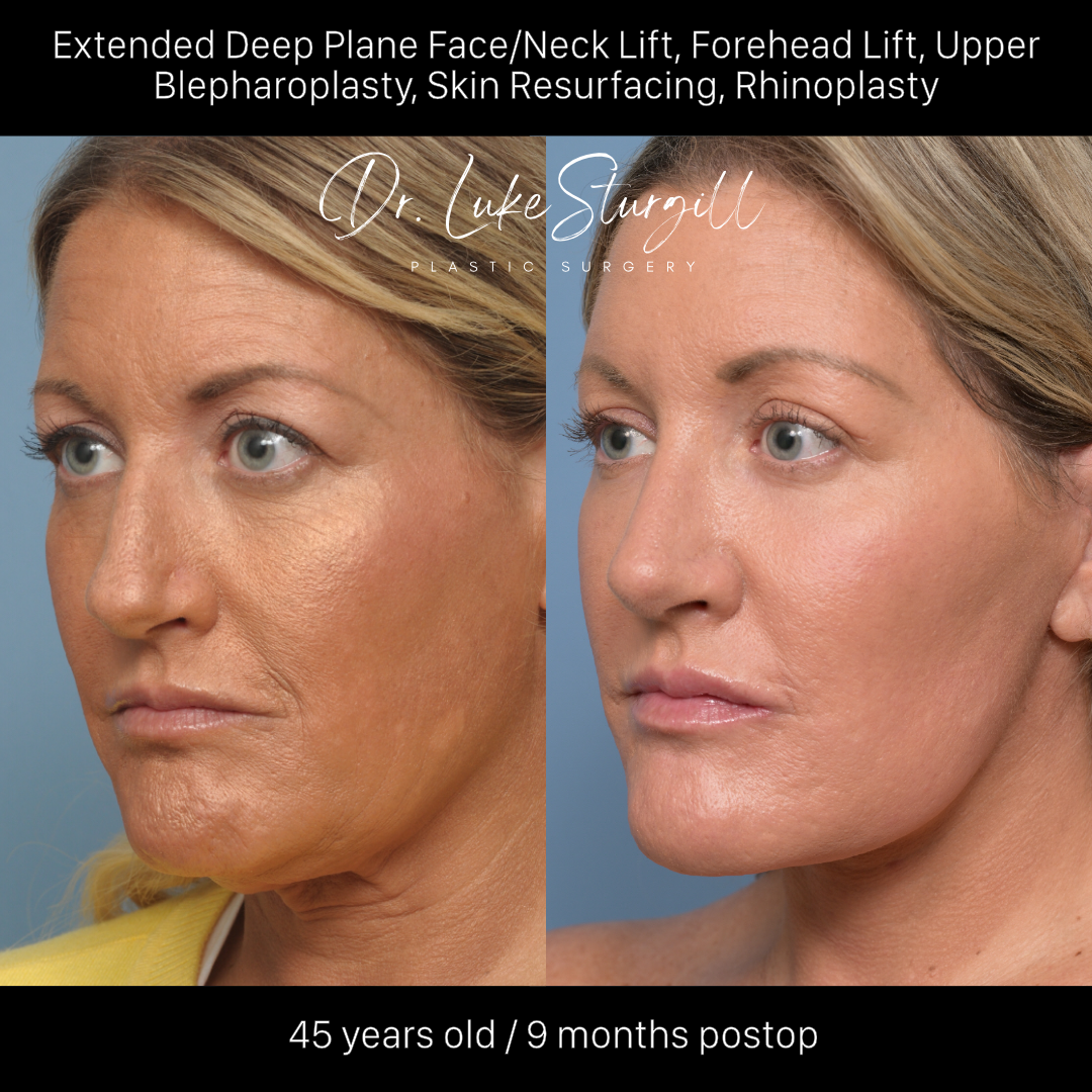 Deep plane facelift before and after — oblique view — female patient