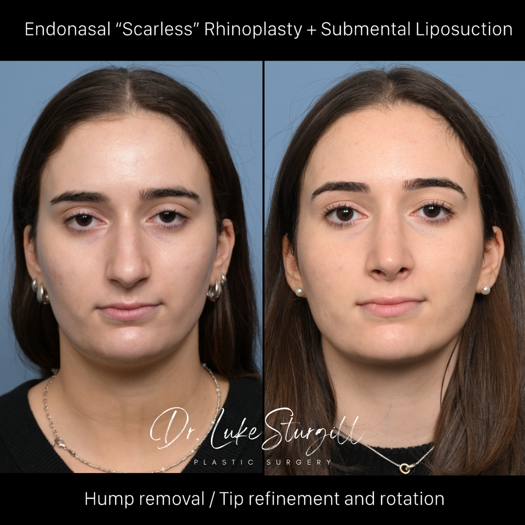 Rhinoplasty before and after — front view — female patient