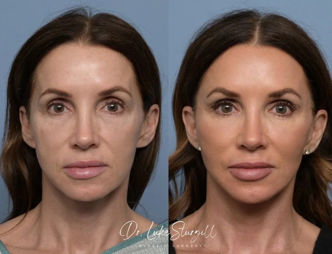 50-year-old patient before and after facial fat grafting with Dr. Sturgill
