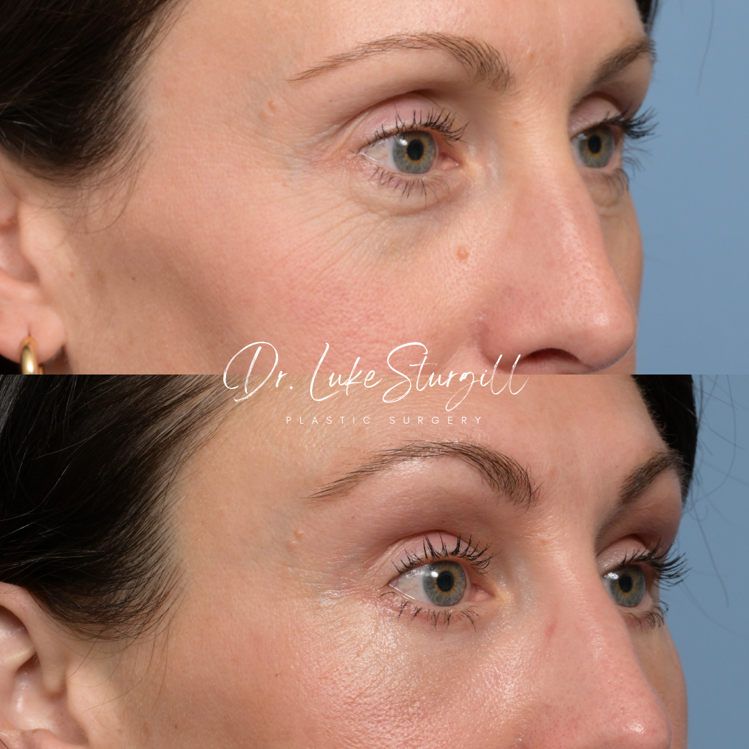 Brow lift and eyelid surgery before and after — oblique view — female patient