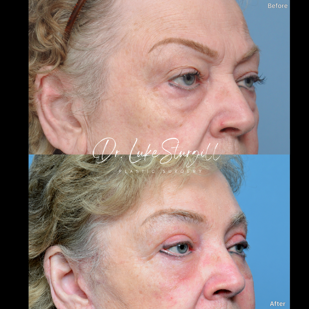 Eyelid surgery before and after — front view — female patient
