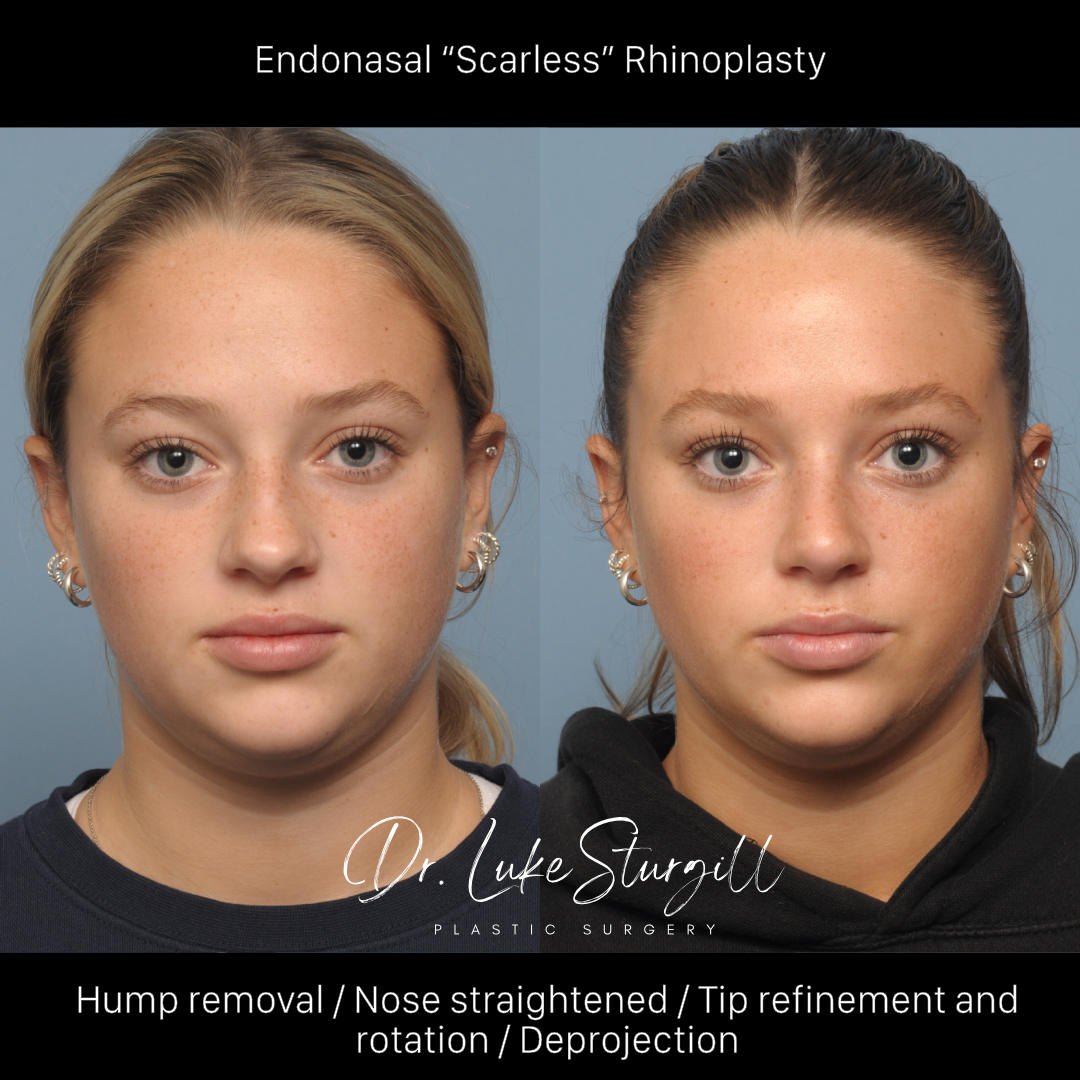 Rhinoplasty before and after — lateral view — female patient