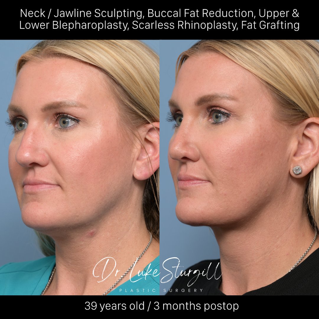 Jawline contouring before and after — oblique view — male patient