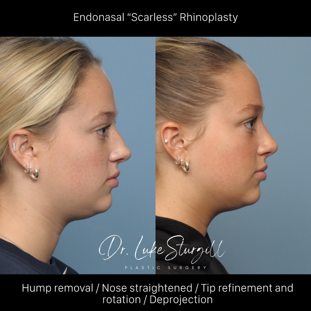 Rhinoplasty before and after — oblique view — female patient