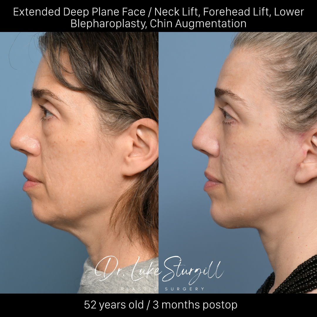 Deep plane facelift before and after — front view — female patient