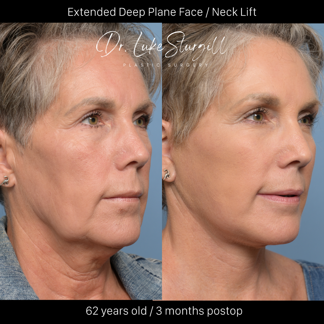Before and after extended deep plane face and neck lift — 62-year-old woman, 3 months post-operative, performed by Dr. Sturgill at Meridian Plastic Surgeons