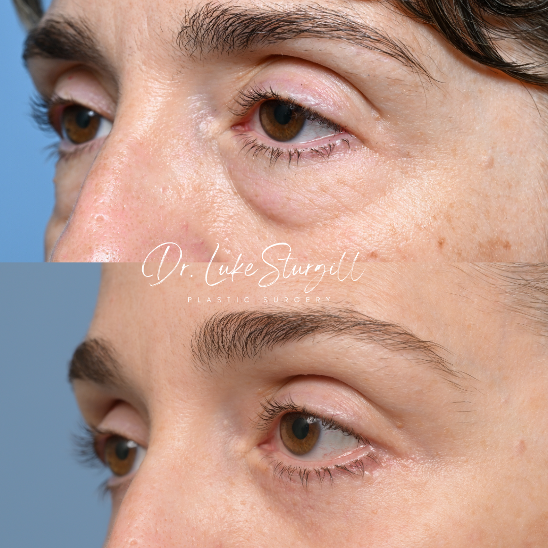 Eyelid surgery before and after — lateral view — female patient