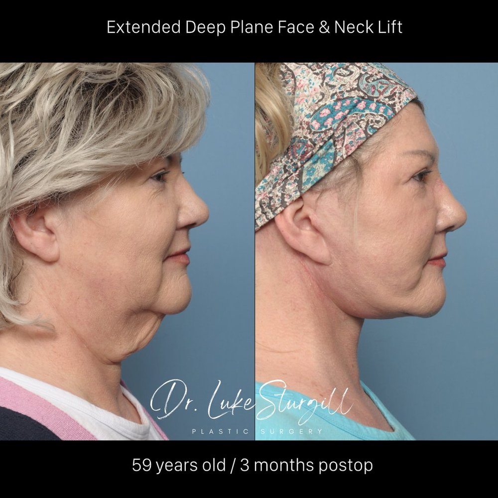 Extended deep plane face and neck lift before and after — lateral view — female patient