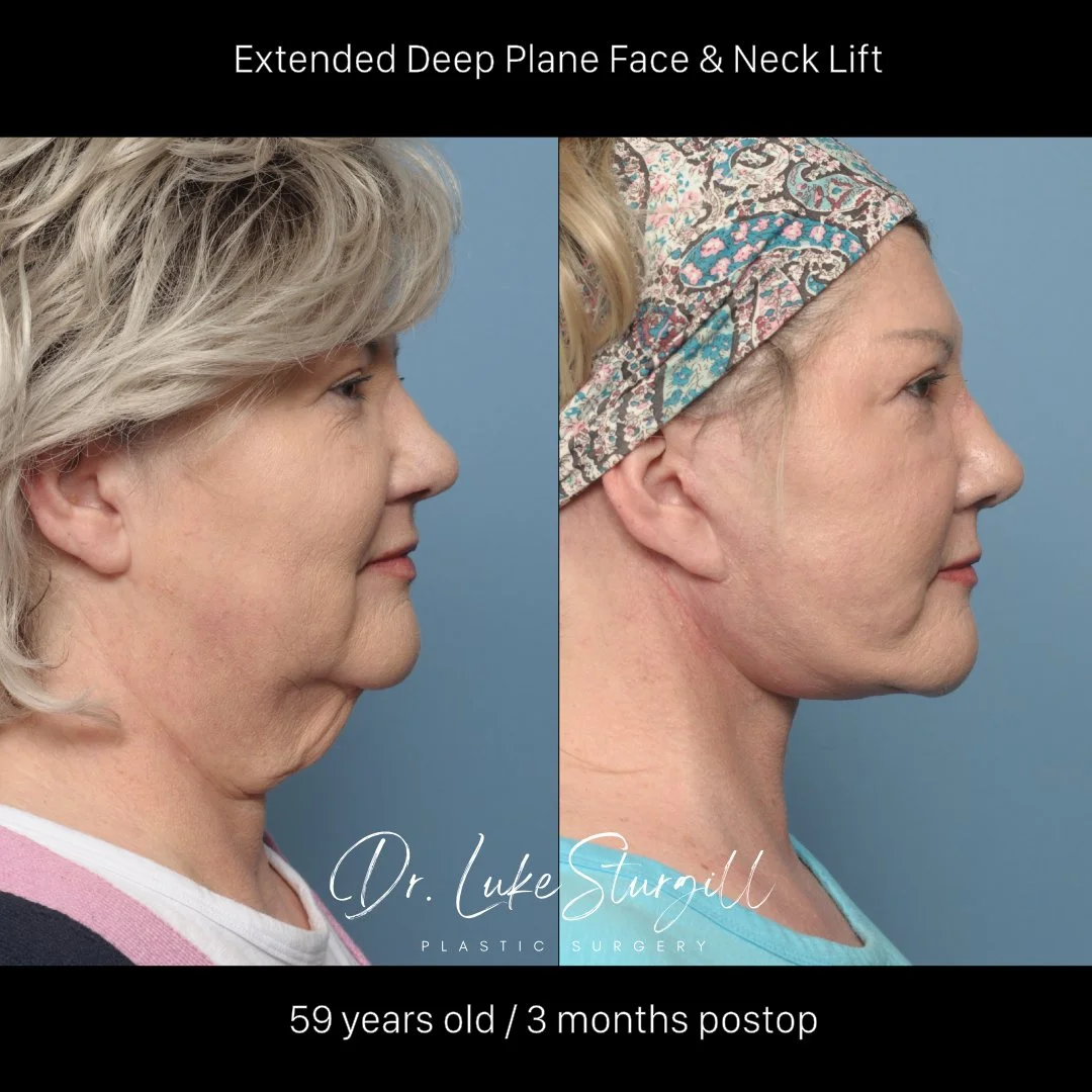 Deep plane facelift before and after — front view — female patient