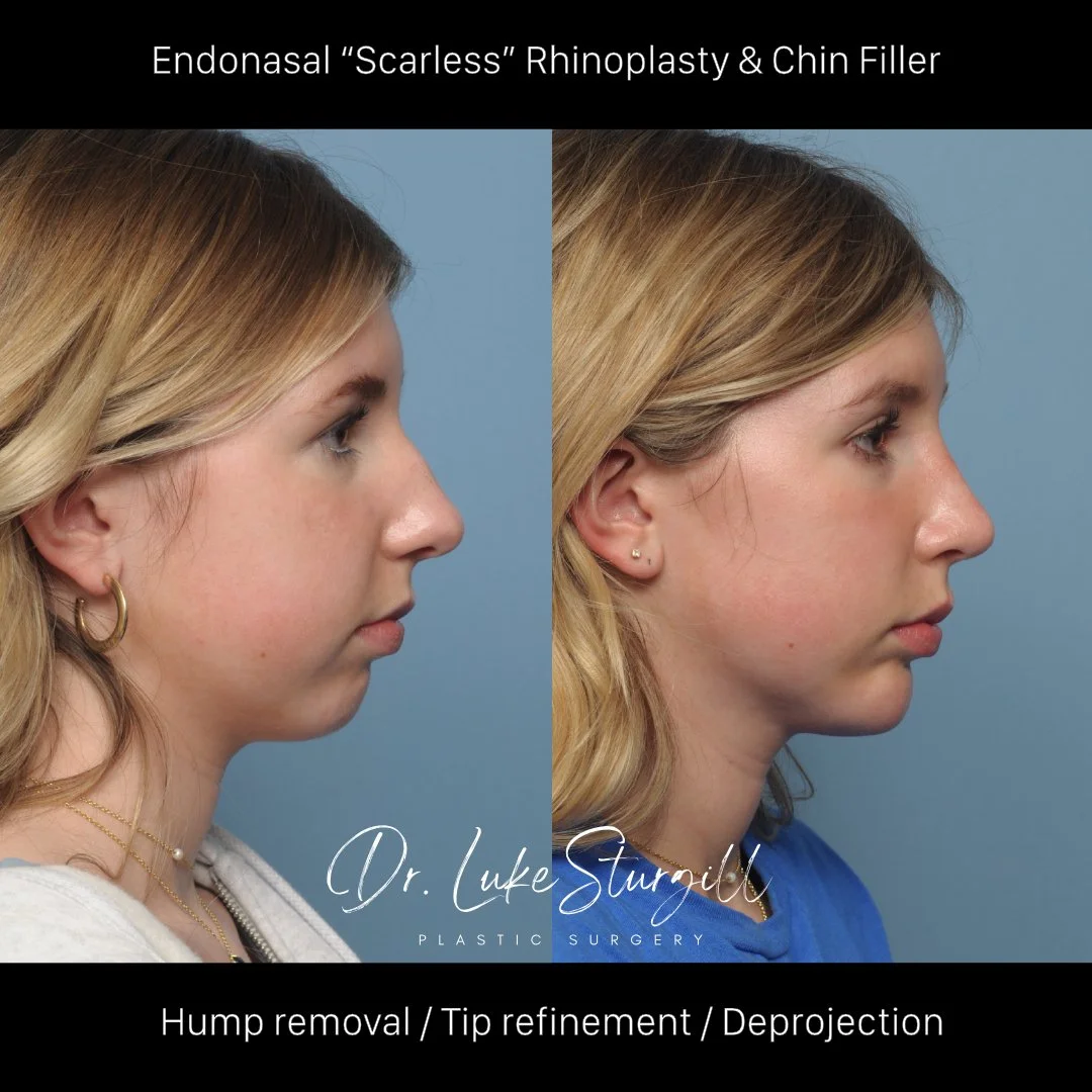 Rhinoplasty before and after — front view — female patient
