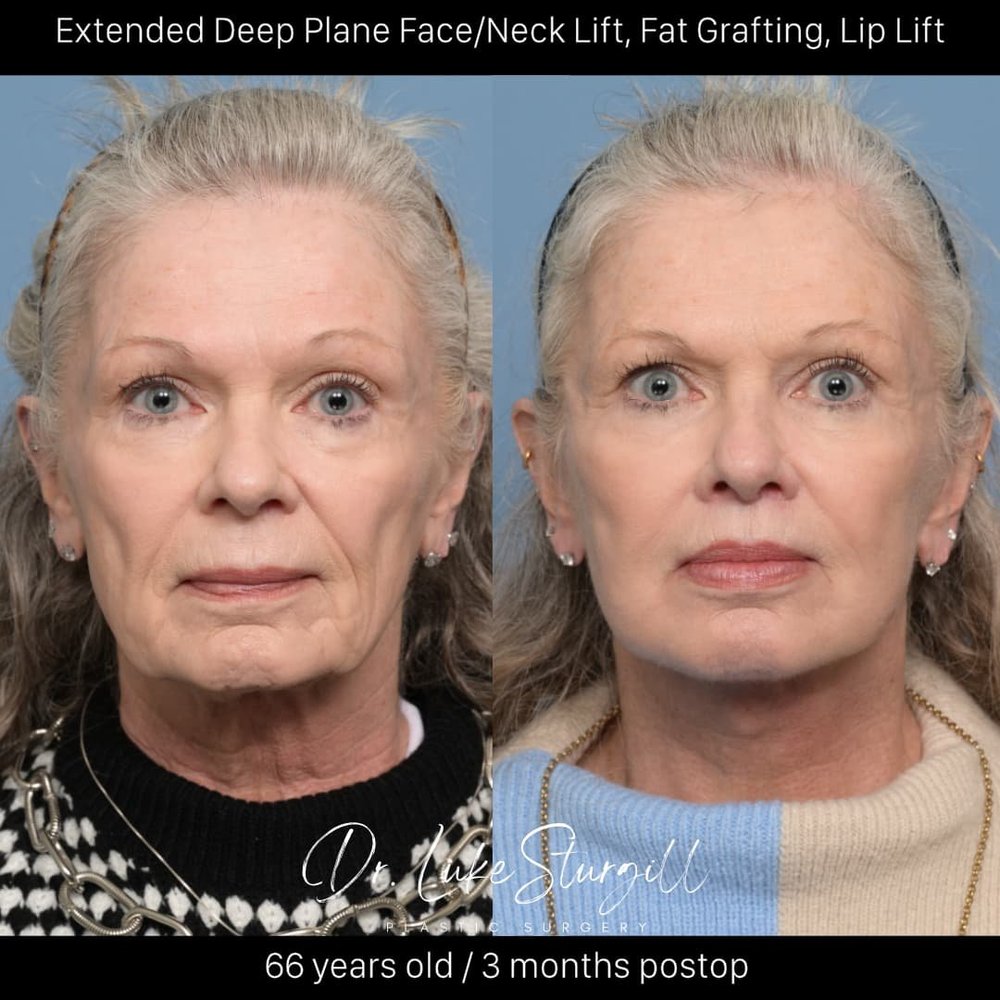 Extended deep plane face and neck lift with fat grafting and lip lift before and after — front view — three months post-op